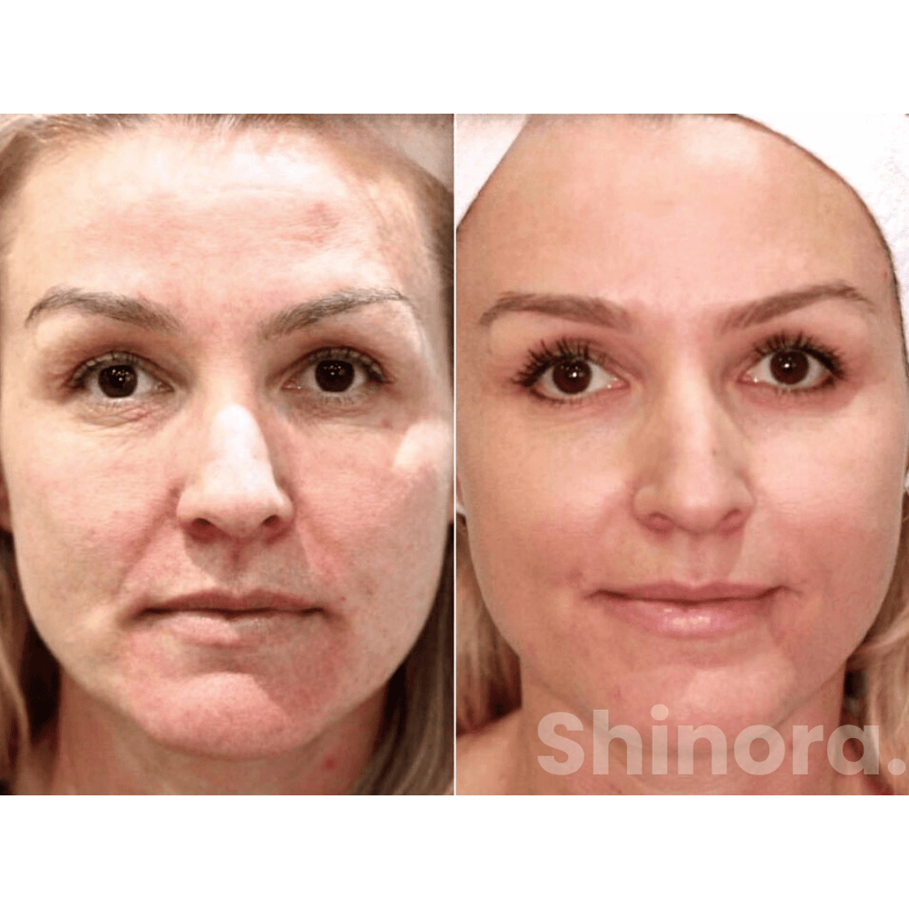 DermiGlow Vorher-Nachher Ergebnis