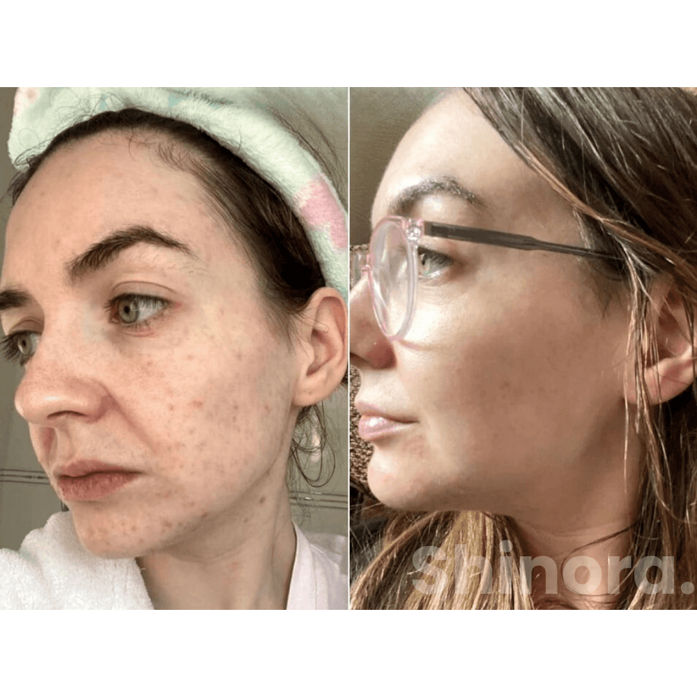 DermiGlow Vorher-Nachher Ergebnis
